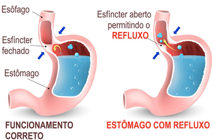 como ocorre o refluxo